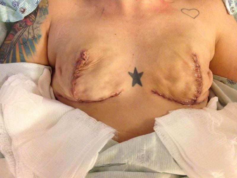 Suzies scars after breast cancer operation 
